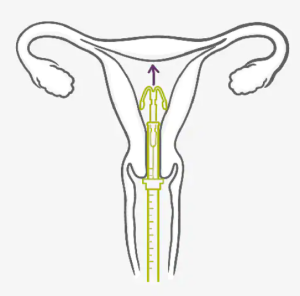 图片[3]-宫内节育系统（IUS）-性教育网