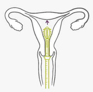 图片[3]-宫内节育器（IUD）-性教育网