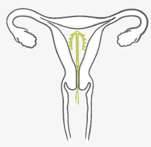 图片[4]-宫内节育器（IUD）-性教育网